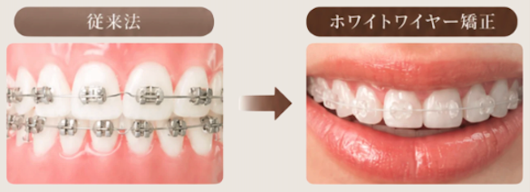 従来法とホワイトワイヤー矯正の比較