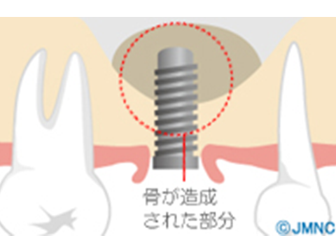 上顎洞底挙上術(ソケットリフト)