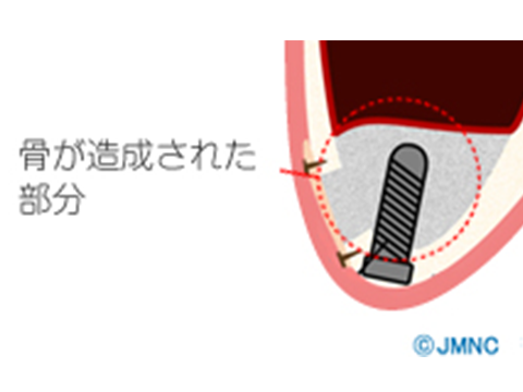 上顎洞底挙上術(サイナスリフト)