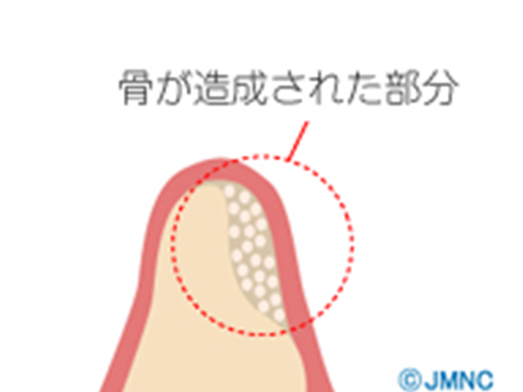 GBR(骨再生誘導法)